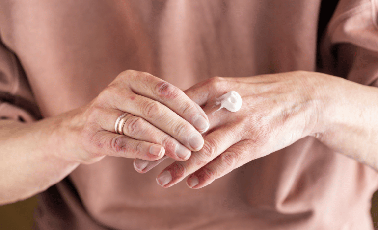 Managing Hand Eczema: Tips and Treatments for Healthy Skin